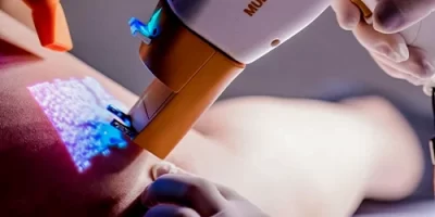 esclero-laser-transdermico
